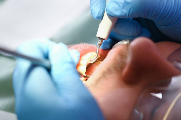 Best Emergency Wisdom Teeth Removal in Arkoma, OK